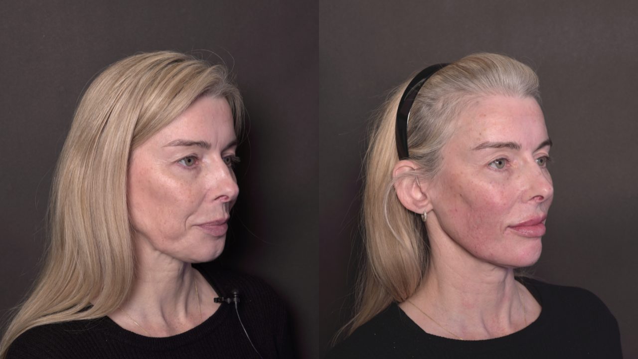 Full-face treatment result